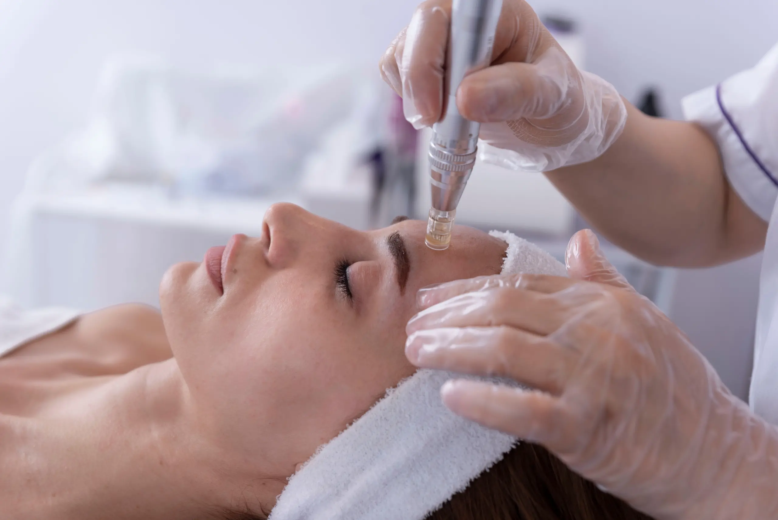 Microneedling Treatment