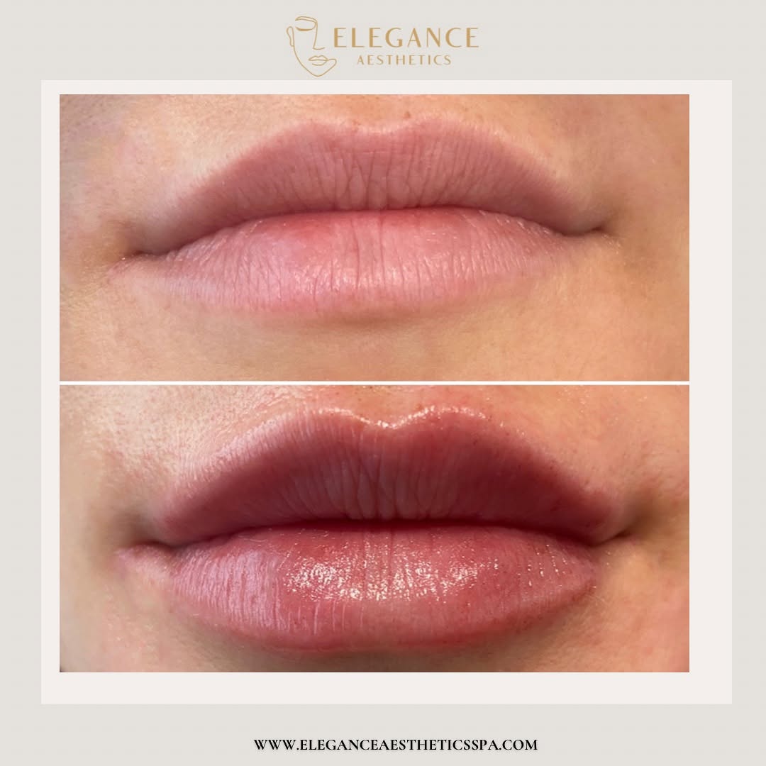 Lip Filler Treatment